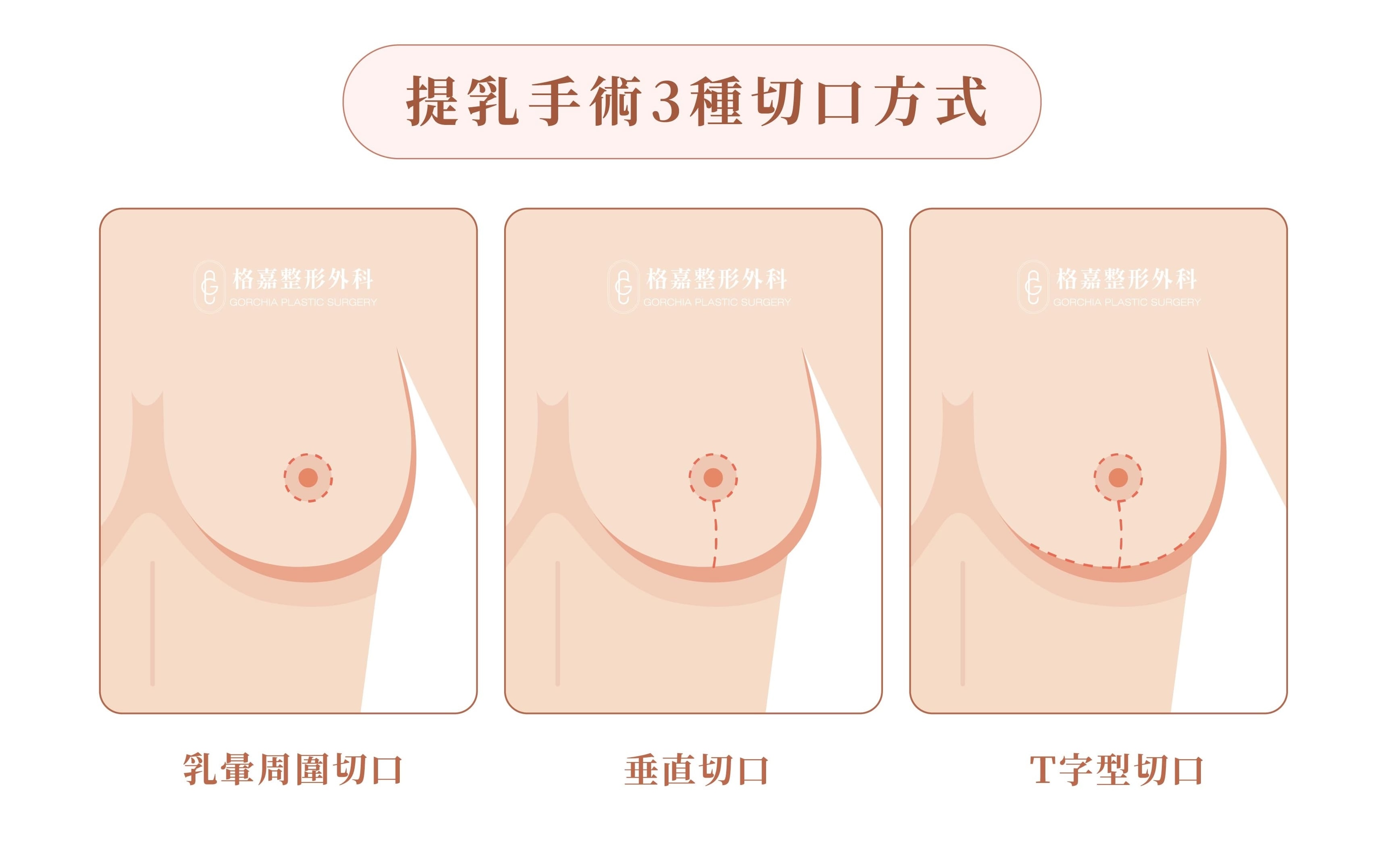 提乳手術切口